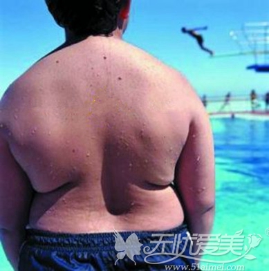 郑州吸脂减肥