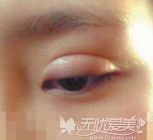 金华芘丽芙埋线双眼皮手术恢复期