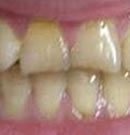 在深圳凯伦口腔做炫彩美白牙齿技术,黑牙成功美白整形案例!术前