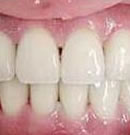 在深圳凯伦口腔做炫彩美白牙齿技术,黑牙成功美白整形案例!术后