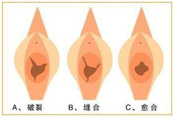 韩国如妍妇科医院处女膜修复手术