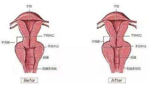 韩国如妍妇科激光阴道紧缩术