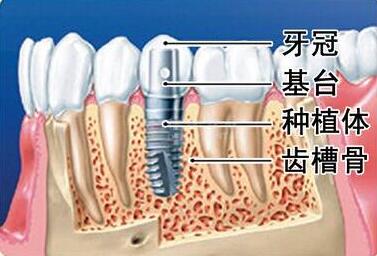 深圳凯伦口腔连锁机构引进的凯伦即刻种植牙系统，源于种植牙发源地