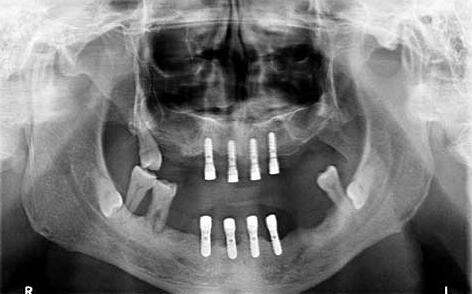 X光片显示胡先生原先的种植周围骨吸收严重、后牙也未恢复