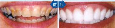 北京圣贝口腔医院四环素牙美白成功整形案例