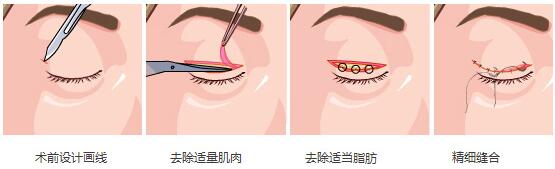 上海安平切开式双眼皮手术