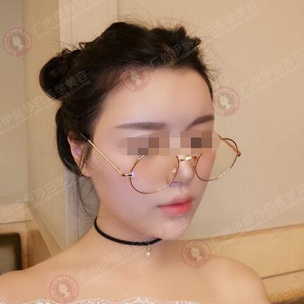 97年妹子在广州伊丽莎白做自体脂肪填充面部后第15天照片