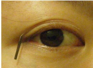 上海芙艾压线双眼皮手术