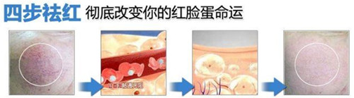 韩国延世罗姿丽激光去红血丝