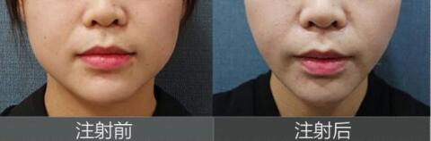 大连名媛医疗美容诊所瘦脸效果对比图