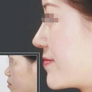 北京美丽有约诊所自体耳软骨隆鼻手术效果图