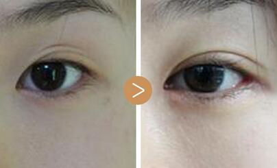 泉州晋江青阳东方整形双眼皮手术整形案例