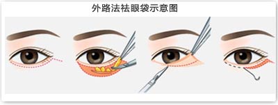 郴州唯美祛眼袋手术