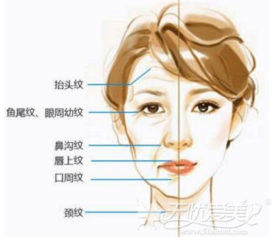 面部常见的的皱纹种类