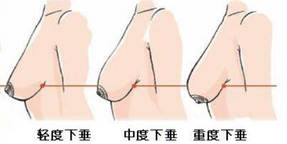 重庆原辰乳房下垂矫正手术