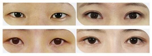 开眼角+双眼皮效果对比案例