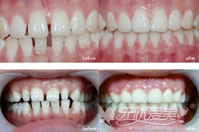 南通摩尔口腔医院3D超薄明星牙齿瓷贴面案例