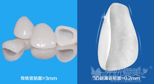 南通摩尔口腔医院3D超薄明星牙齿瓷贴面和普通牙齿贴面的区别