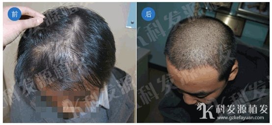 广州科发源RPE植发加密技术 让你摆脱头发稀的问题