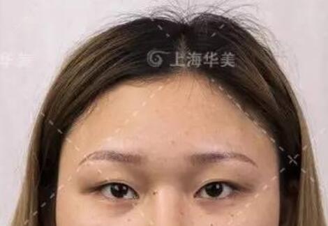 在上海华美做双眼皮术前照片
