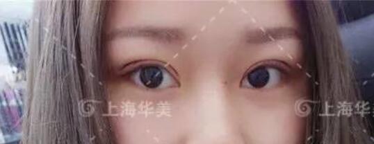 在上海华美做双眼皮术后10-30天为持续消肿阶段/时期