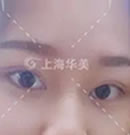 上海华美杨亚益双眼皮整形案例,附双眼皮术后恢复5个阶段!