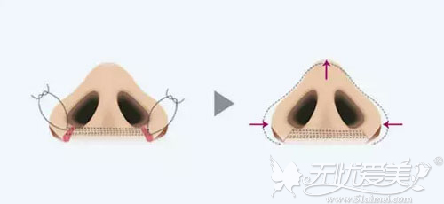 鼻翼宽大+鼻底宽大手术方案
