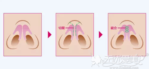 鼻软骨形态异常导致鼻翼肥大手术方案
