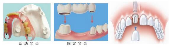 修复缺失的牙齿，通常有种牙和镶牙两种方法