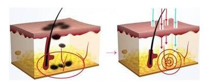 南阳天后激光祛黄褐斑原理