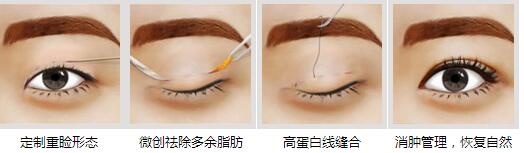 锦州斯美诺隐性埋线法双眼皮手术过程