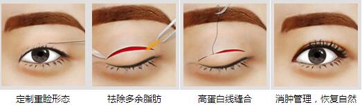 锦州斯美诺定位切开法双眼皮手术过程
