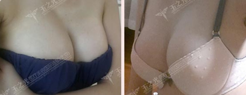 瑶瑶在北京玉之光做自体脂肪丰胸术后1个月