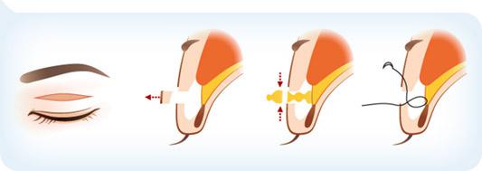 日照美丽华双眼皮隐双的修复方法