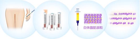 日照美丽华自体脂肪丰太阳穴