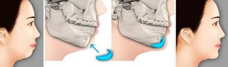 假体隆下巴术是一项口腔内小切口植入假体的外科手术