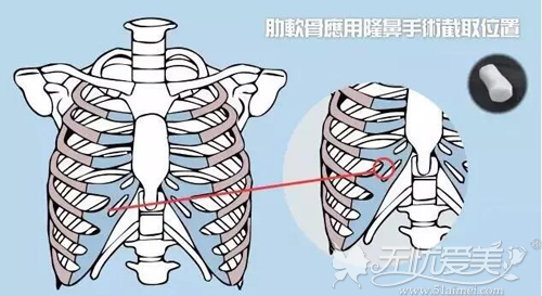 肋软骨隆鼻截取位置