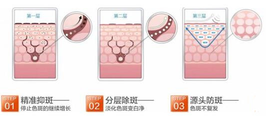 上饶肖发才激光祛斑