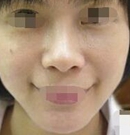 在武汉西婵康美做了激光去眼袋让我减龄5岁