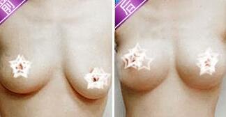 武汉艺君美韩乳房下垂矫正手术效果对比图