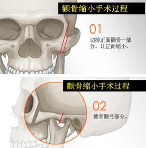 长沙彭栋梁颧骨整形手术