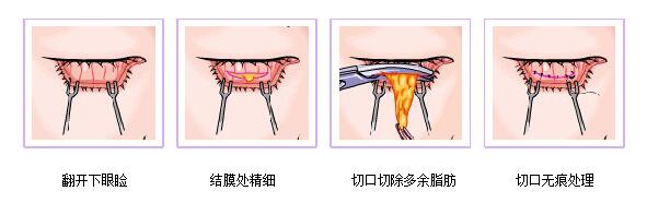 长沙南湖祛眼袋手术过程