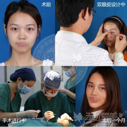 上海伊莱美双眼皮手术真人案例
