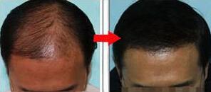 武汉华美植发中心自体毛发移植手术效果图