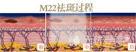 南宁梦想M22王者之心祛斑过程