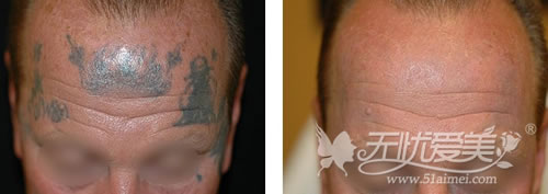 伤疤激光仪去纹身前后对比案例