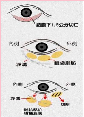 外切口祛眼袋图解手术第1步:严格的对眼部进行消毒处理,一般正规的