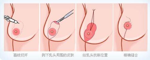 乳房下垂矫正手术方式