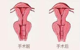 惠州伊丽莎白阴道紧缩术对比图