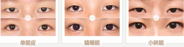 北京叶子双眼皮手术案例